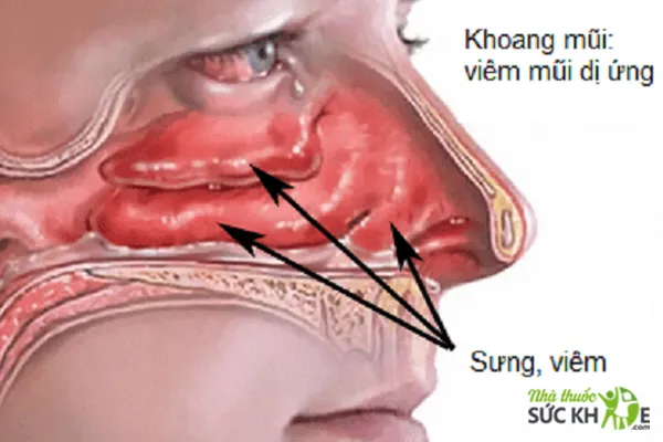 Khoang mũi và mũi bị sưng, viêm